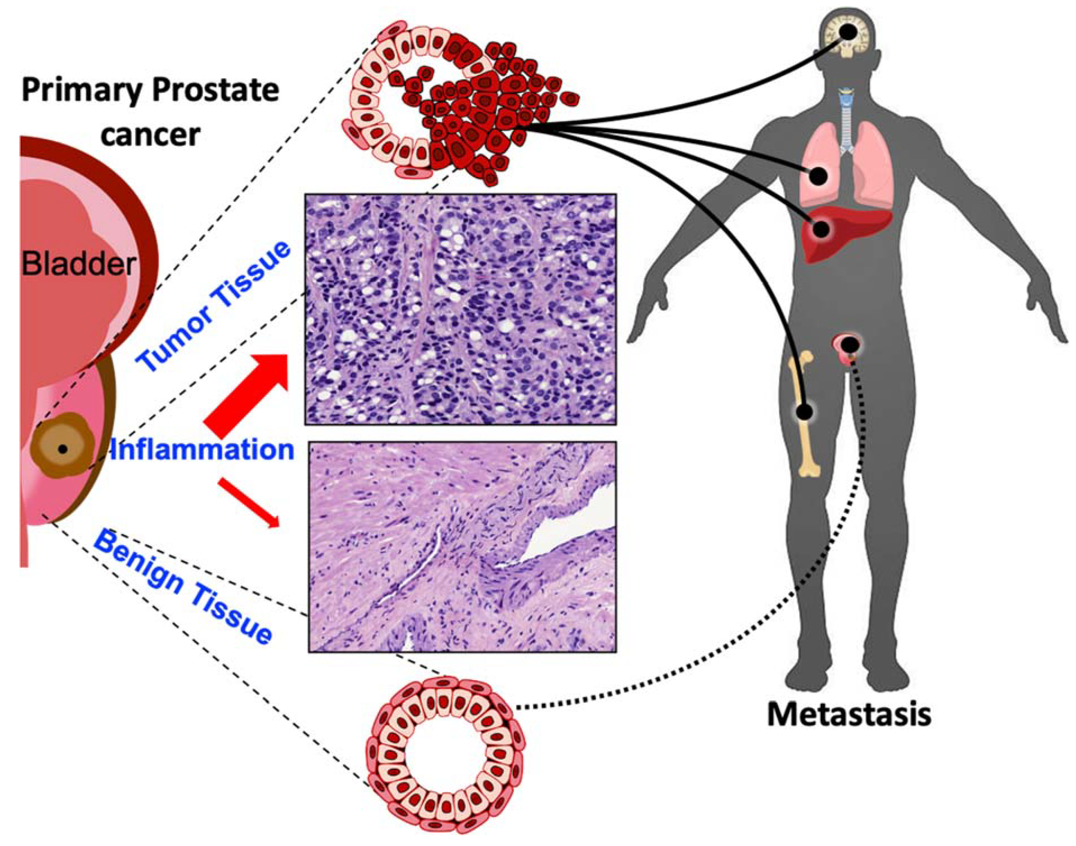 Suspected metastasis of prostate cancer Alamogordo